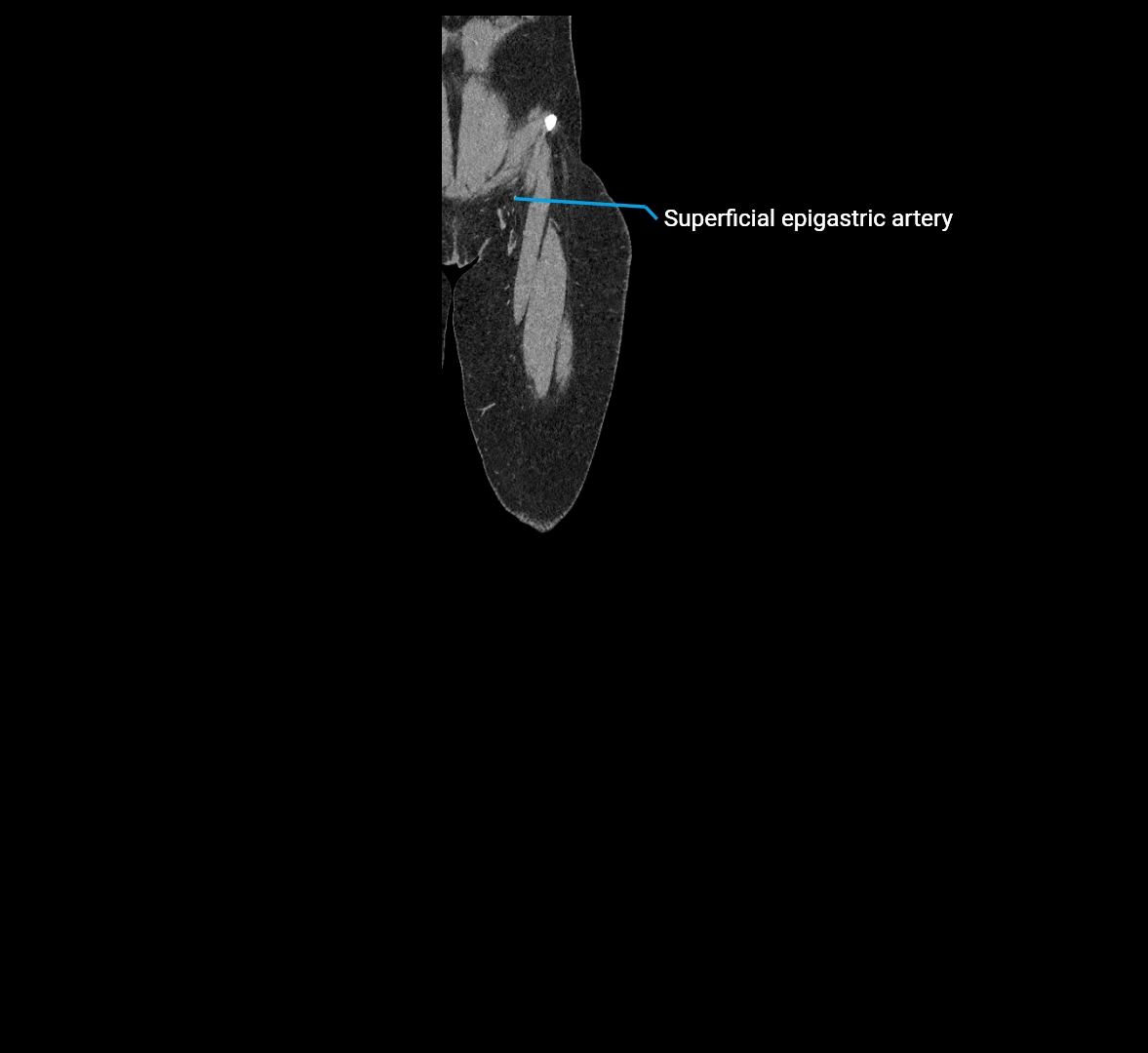 CTA lower limb coronal cross sectional anatomy labelled image _6 (1).webp
